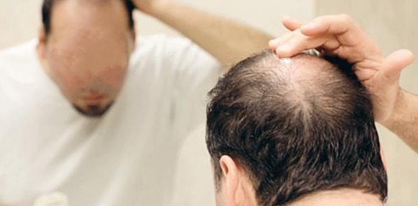 العلاج النهائي لتساقط الشعر و الفراغات