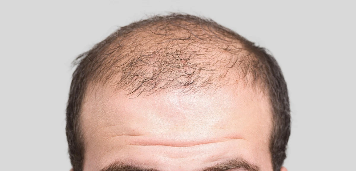 العلاج النهائي لتساقط الشعر و الفراغات